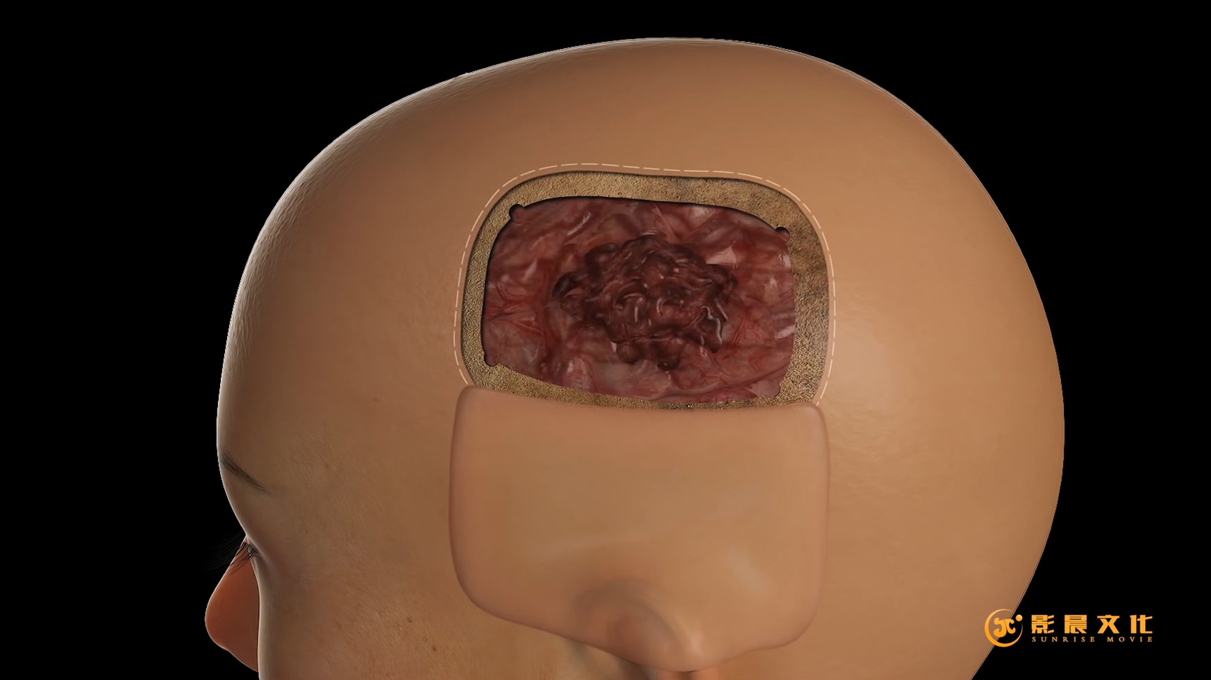 廣州病毒感染三維動畫